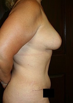 Mommy Makeover Before & After