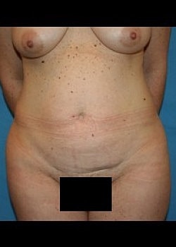 Tummy Tuck Before & After