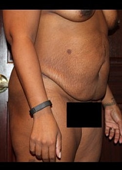 Tummy Tuck Before & After