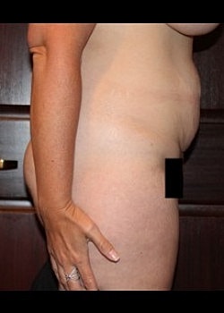 Tummy Tuck Before & After