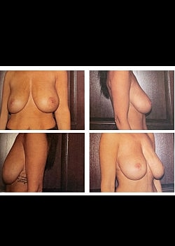 Breast Lift Before & After