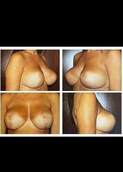 Breast Lift Before & After