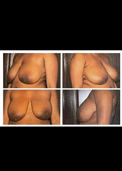 Breast Lift Before & After