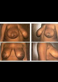 Breast Lift Before & After