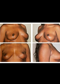 Breast Lift Before & After
