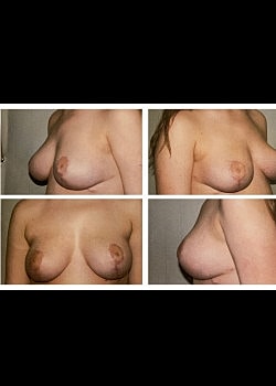 Breast Lift Before & After