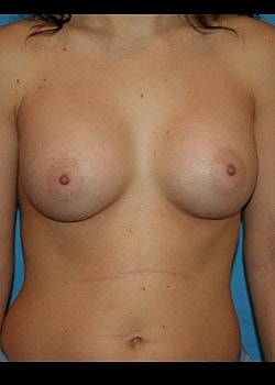 Breast Augmentation Before & After