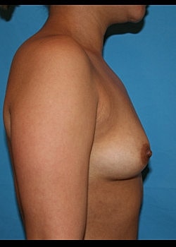 Breast Augmentation Before & After
