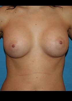 Breast Augmentation Before & After
