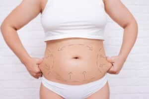 A woman holding her stomach, which has been marked for a mommy makeover procedure